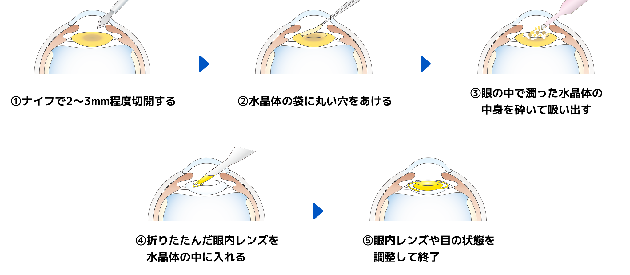 ①ナイフで2〜3mm程度切開する ②水晶体の袋に丸い穴をあける③目の中で濁った水晶体の中身を砕いて吸い出す ④折りたたんだ眼内レンズを水晶体の中に入れる ⑤眼内レンズや目の状態を調整して終了