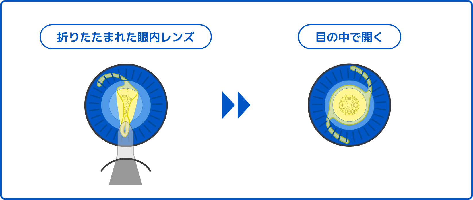 折りたたまれた眼内レンズ 目の中で開く
